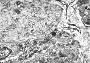 F,25y. | myopathy - atrophic and regenerating muscle cells